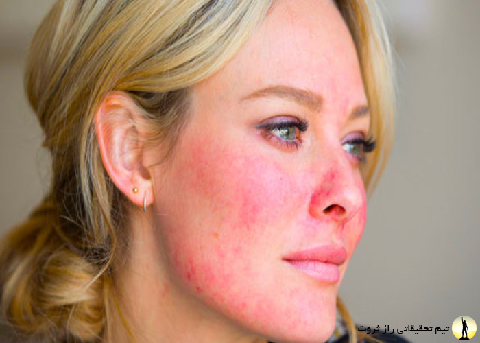 تاثیر استرس بر سلامت بدن