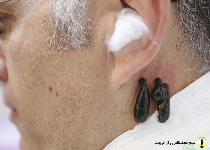 زالو درمانی چیست